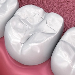 Digital image of a tooth on the bottom row receiving a tooth-colored filling