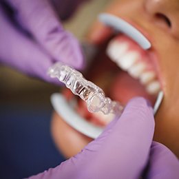 dentist putting aligner in patient’s mouth 