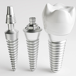 Dental implant in Arlington and its parts