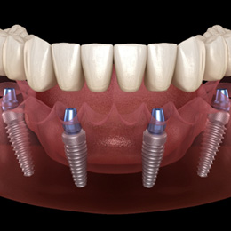 A 3D illustration of All-on-4 dentures