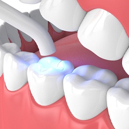 Digital image of curing light hardening the composite resin used for a tooth-colored filling