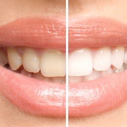 A before and after photo of smile after teeth whitening
