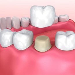 Dental crown in Arlington 