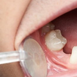 patient with gap in smile 