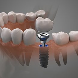 Dental implant in Arlington