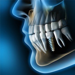 3 D image of dental implant supported dental crown in smile