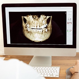 Software for computer guided dental implant surgery