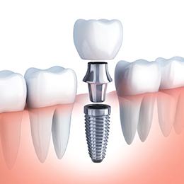 illustration of implant, abutment, and crown
