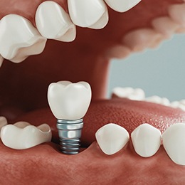 Diagram of a dental implant with surrounding teeth
