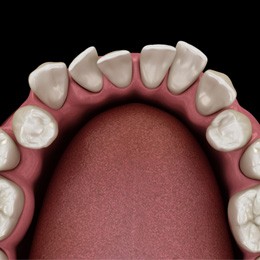 model of crowded teeth