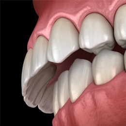 model of an overbite