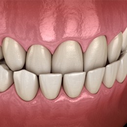 model of an underbite