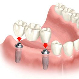 Computer model of implant-retained fixed bridge