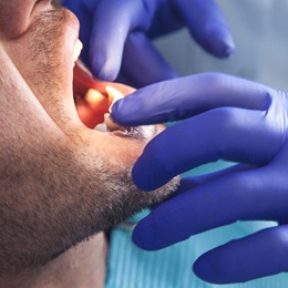 A dentist performing an oral cancer screening on a male patient