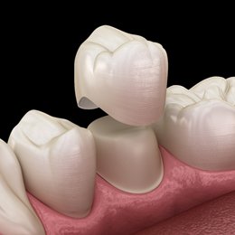 Animated dental crown placement process