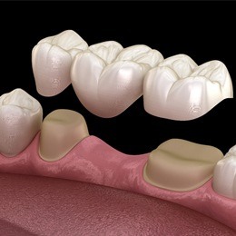 Animated dental bridge placement process