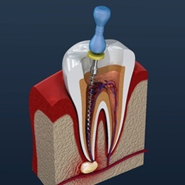 Diagram of a root canal procedure