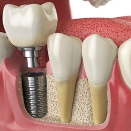 Animated single dental implant placement process
