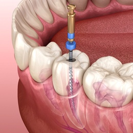 Digital image of a dental instrument being used to reach the infected pulp area of the tooth