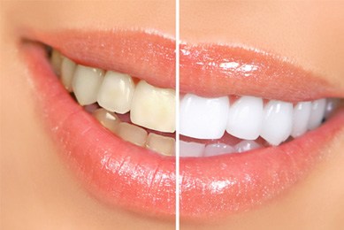 Before and after teeth whitening in Arlington  