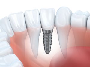 The cost of dental implants in Arlington pays off over the course of a lifetime. 