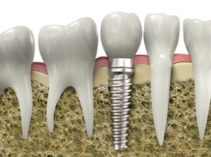 dental implants in Arlington