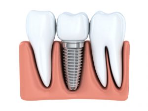 You need extensive tooth replacement. You feel you are faced with an “either/or” choice: dentures or dental implants. Dr. Douglas Baldwin of Foundation Dental Solutions in Arlington will guide you through the decision so your smile is strong, beautiful and long-lasting.