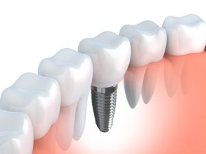 Missing teeth affect your looks and oral function. Learn why you should replace them with dental implants in Arlington or other prosthetic options.