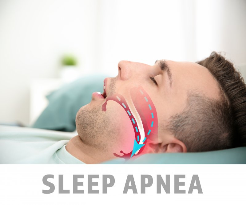 a young male asleep with the words “sleep apnea” and a diagram showing his inability to breathe properly