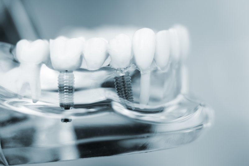 a mouth mold with an implant bridge