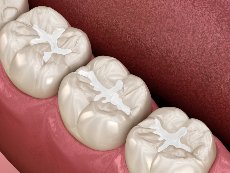 tooth-colored fillings