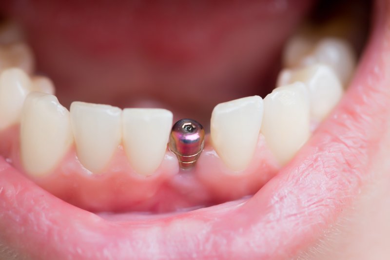 A patient’s mouth after a dental implant surgery