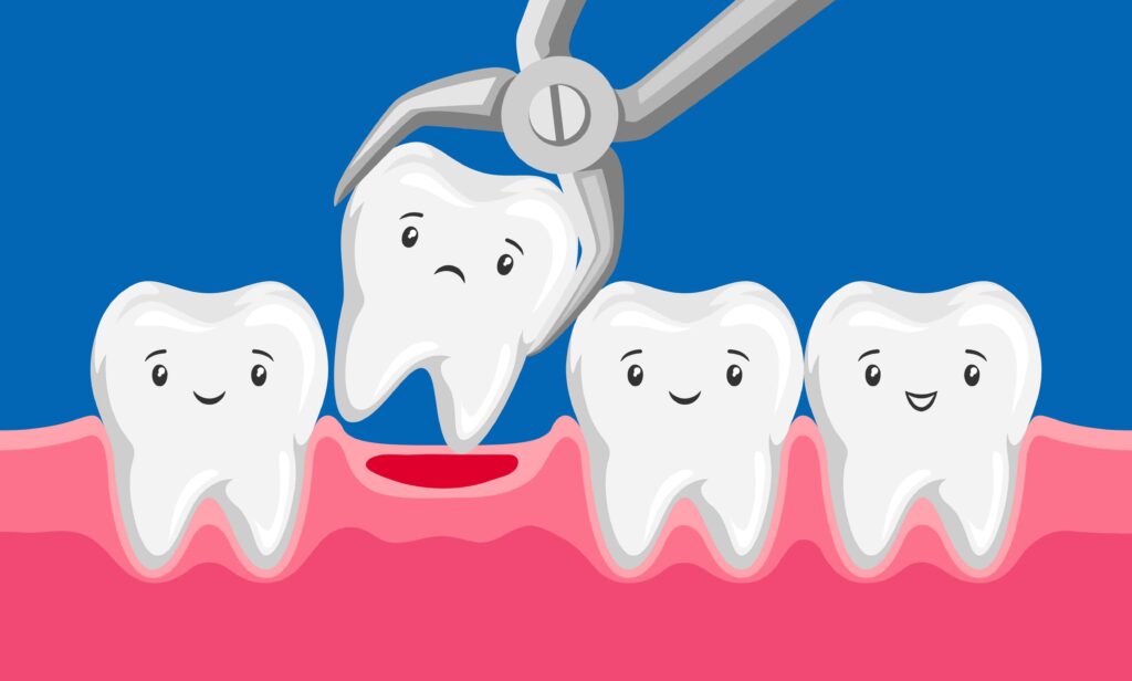 Illustration of a tooth being removed