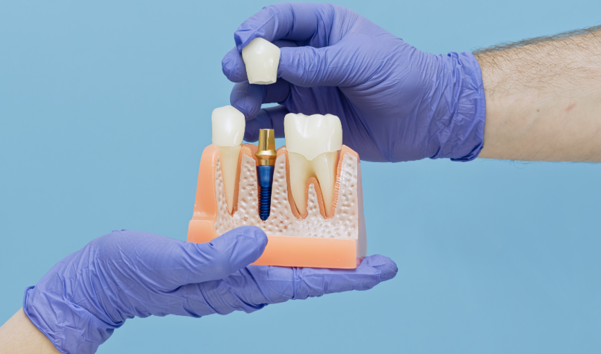 Model dental implant